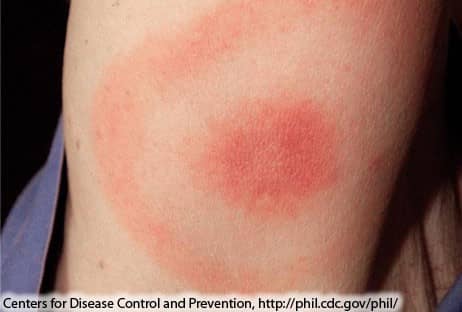 What Does Lyme Disease Rash Look Like   Lyme Disease Rash 1a 